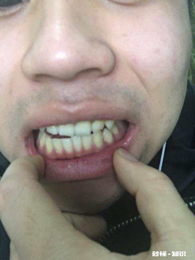 “箍牙变脸”真的有用吗