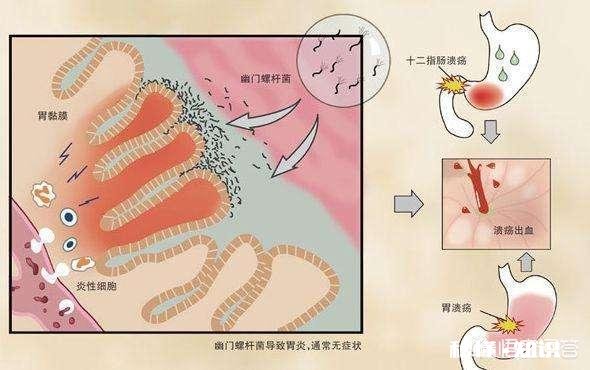 胃溃疡喜欢“缠上”这3类人，是指哪三类人