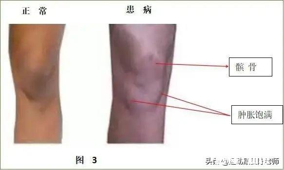 x型腿如何通过运动矫正