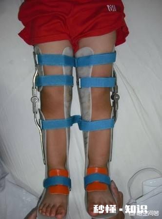 x型腿如何通过运动矫正