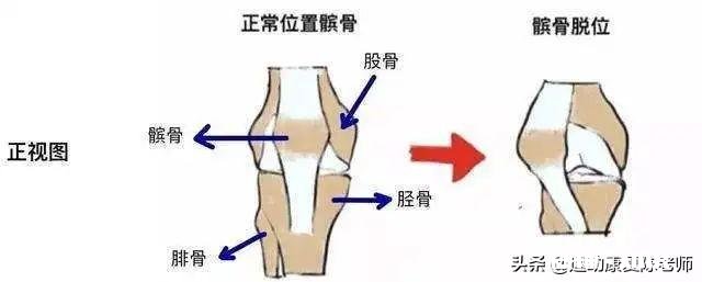 x型腿如何通过运动矫正