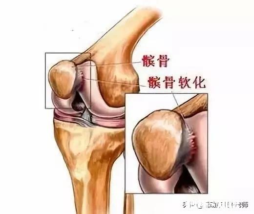 x型腿如何通过运动矫正