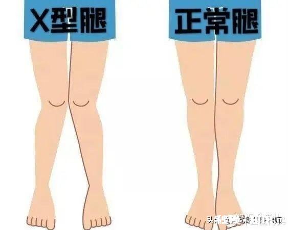 x型腿如何通过运动矫正