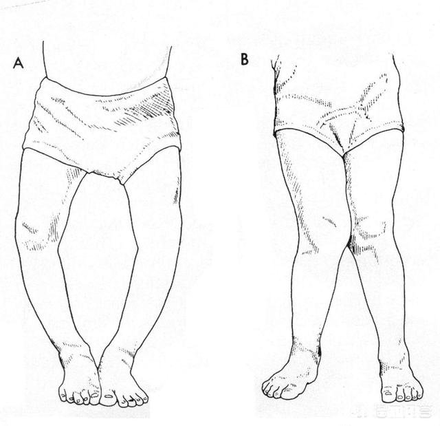 x型腿如何通过运动矫正