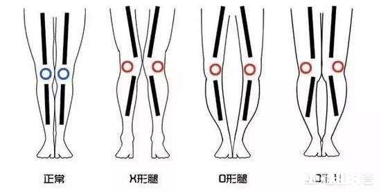 x型腿如何通过运动矫正