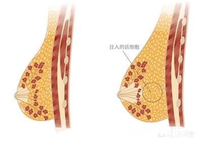 自体脂肪丰胸到底会不会影响以后母乳