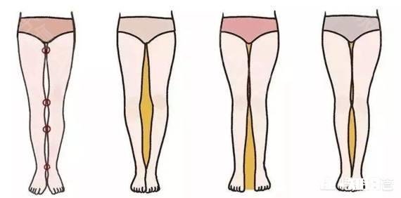 吸脂减肥适合哪些人