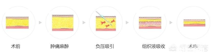 吸脂减肥适合哪些人