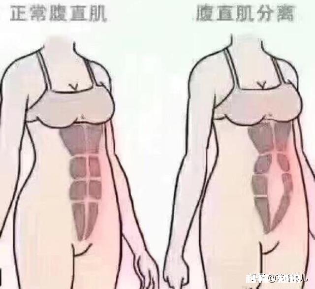 产后如何快速恢复大肚子，生完娃医生为啥让我们用收腹带，真的有用吗