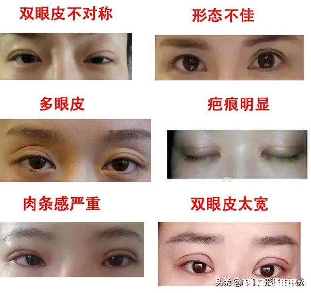 双眼皮手术失败了什么心情