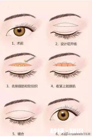 双眼皮手术失败了什么心情