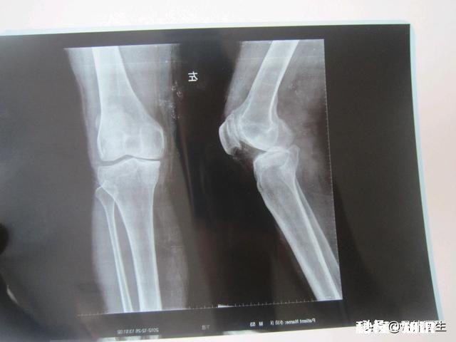 膝关节骨质增生，软骨能再生修复吗