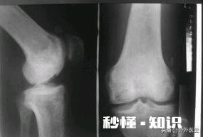 膝关节骨质增生，软骨能再生修复吗