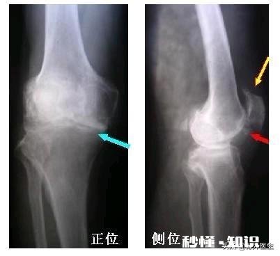 膝关节骨质增生，软骨能再生修复吗