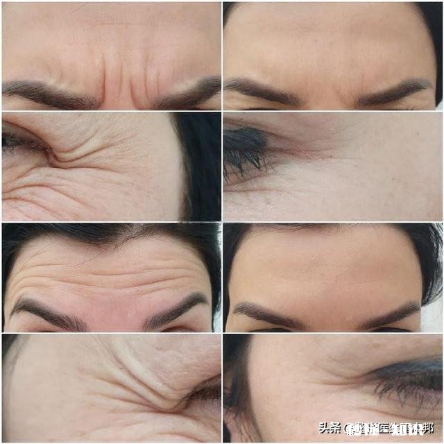 25岁，额头皱纹越来越深，用眼霜护理怎么样