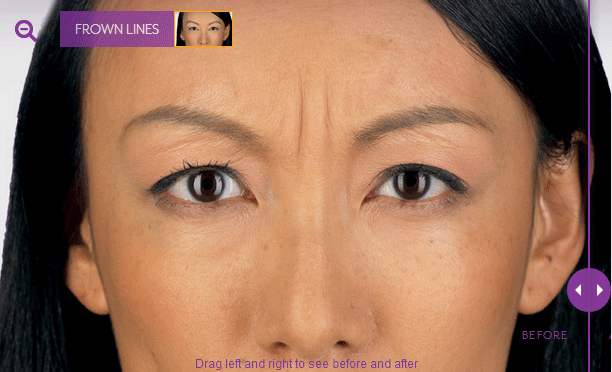 25岁，额头皱纹越来越深，用眼霜护理怎么样