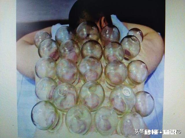 艾灸，刮痧，火罐真的能对人有除湿，改变体质的效果吗