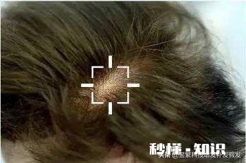 染发剂弄到仿真头皮上怎么处理