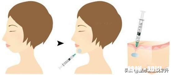 垫下巴适合哪些人