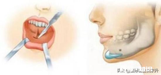 垫下巴适合哪些人
