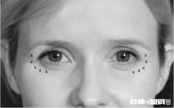 如何去除鱼尾纹