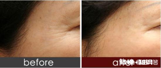 如何去除鱼尾纹