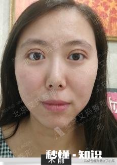 既想变美,又不想别人看出来整形?这是什么心理