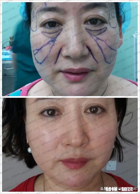 既想变美,又不想别人看出来整形?这是什么心理