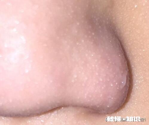 黑头到底如何去有什么大咖经验可以分享