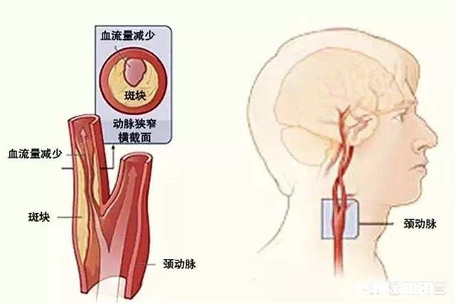 颈部血管堵塞，身体会出现哪些明显的症状