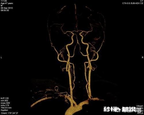 颈部血管堵塞，身体会出现哪些明显的症状