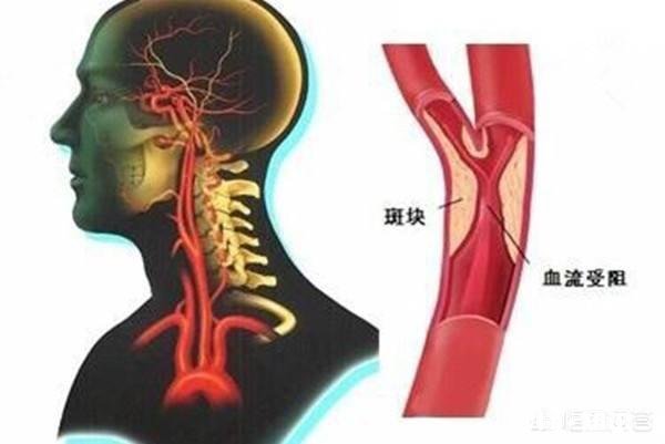 颈部血管堵塞，身体会出现哪些明显的症状