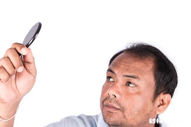 为什么现在的90后都开始脱发了