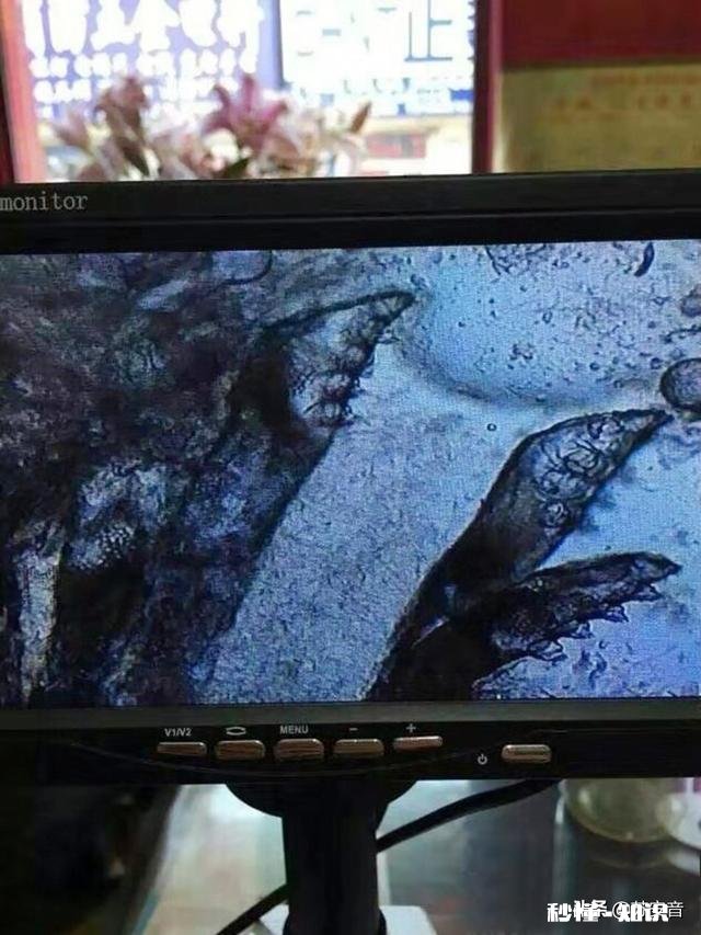 为什么现代女性很多脸上背上都长痘痘