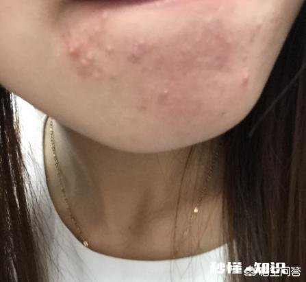 为什么现代女性很多脸上背上都长痘痘