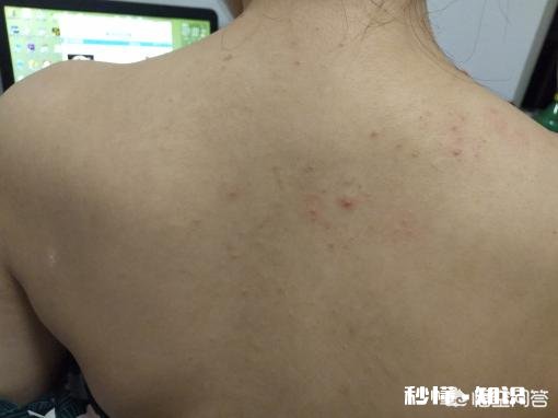 为什么现代女性很多脸上背上都长痘痘