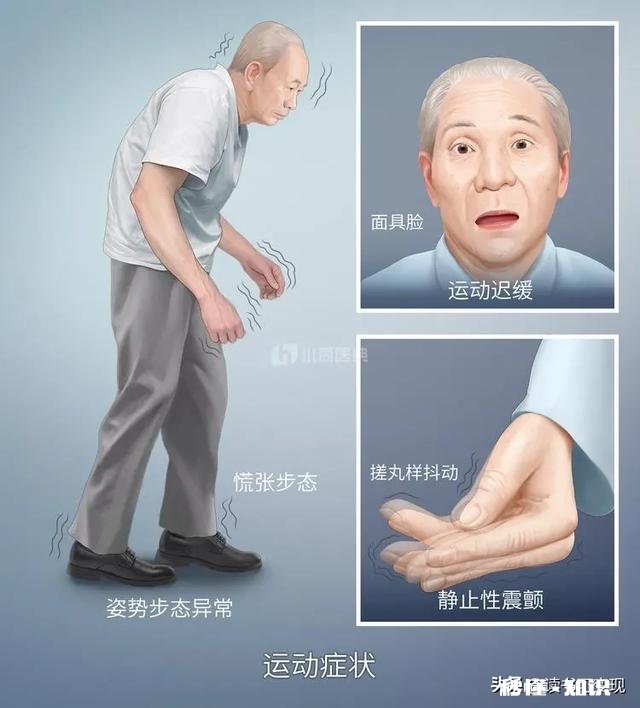 帕金森治不好，患者是不是不用治疗了呢