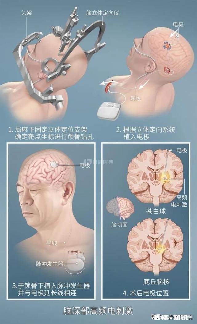 帕金森治不好，患者是不是不用治疗了呢