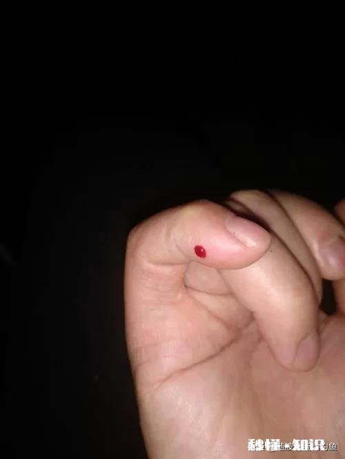 钓鱼时被魚钩扎手，你会去打破伤风针吗