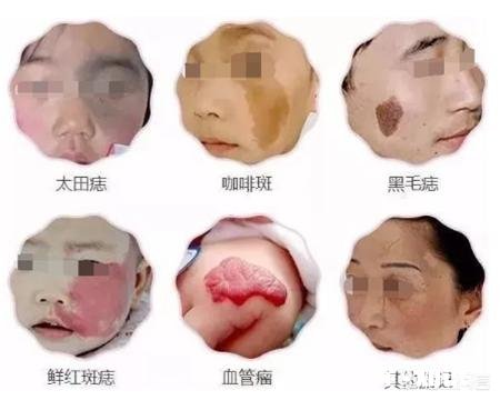 你家宝宝有没有胎记,长什么样
