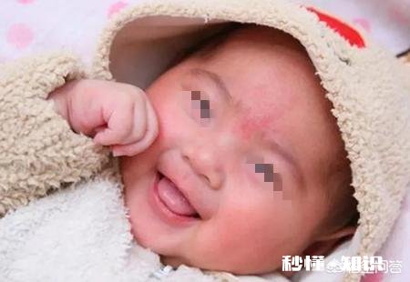 你家宝宝有没有胎记,长什么样