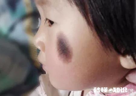 你家宝宝有没有胎记,长什么样