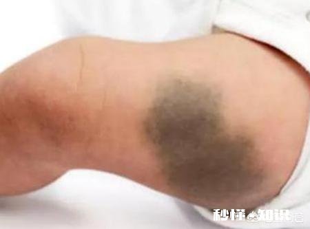 你家宝宝有没有胎记,长什么样