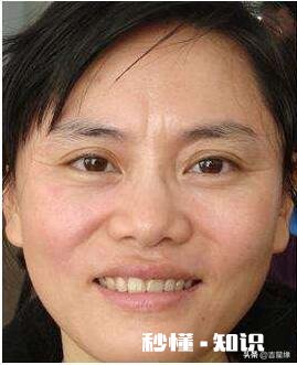 白醋怎么去皱纹