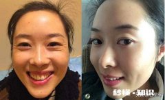 白醋怎么去皱纹