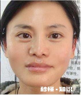 白醋怎么去皱纹