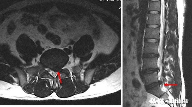 正骨对腰椎间盘突出有效果吗是什么原理呢
