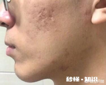 痘痘有那么难去掉吗该怎么祛痘