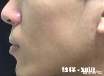 痘痘有那么难去掉吗该怎么祛痘