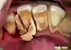为什么牙结石有时候会自己掉下来